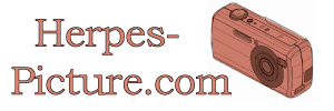 Genital Herpes